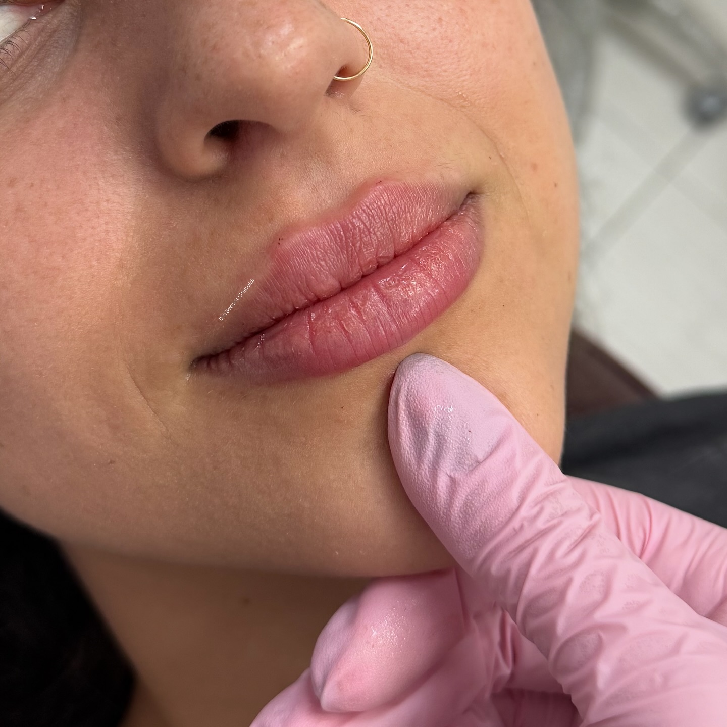 Resultado de preenchimento labial