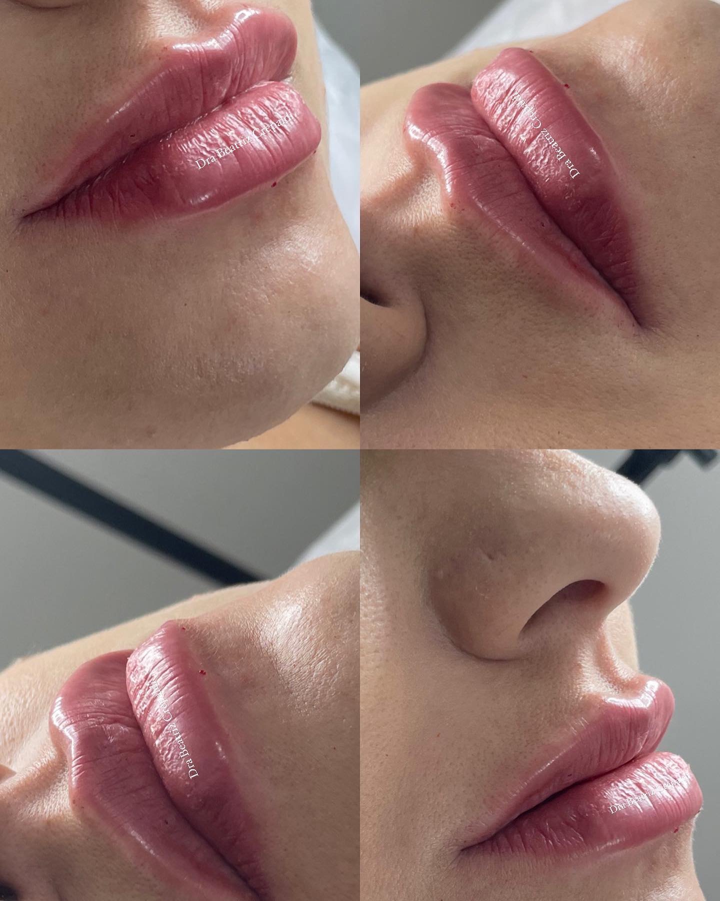 Preenchimento labial em vários ângulos
