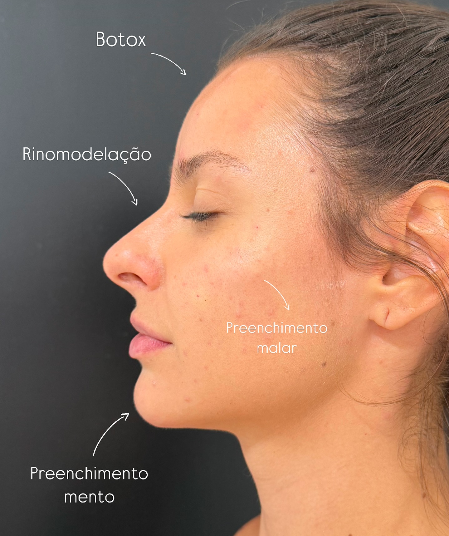 Mapa de harmonização facial: botox na testa, rinomodelação no nariz, preenchimento malar na maçã do rosto e preenchimento de mento